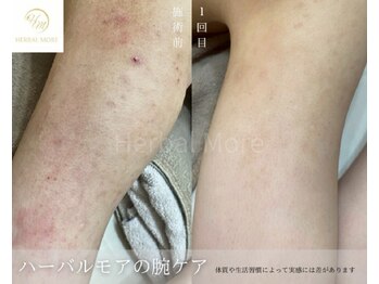 スキニティ 池袋(sknity)/<二の腕>お肌の黒ずみケア