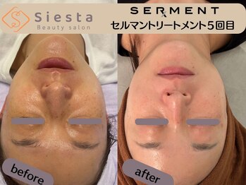 シエスタ(siesta)/艶玉肌トリートメントの経過