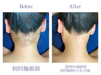 ツルツル美肌脱毛/【レディース脱毛】背中脱毛