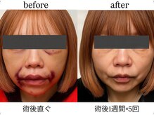 術後インディバ専門サロン 新宿の雰囲気(《リフト/ビフォーアフター》術後インディバ/硬さ内出血緩和)