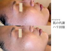 アン(An)/プラズマで真皮層にアプローチ