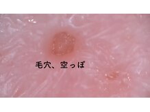 ミント/毛穴コースで頑固な皮脂つまり×