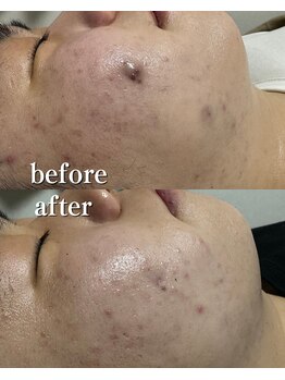 オーシャンハーブ(Ocean Harb)/【ハーブピーリングでモテ肌に】