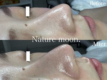 ナチュールムーン(Nature moon.)/毛穴洗浄