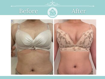 美人バスト 浜松店/◇ バストアップ &nbsp;BeforeAfter◇