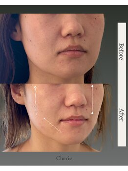 シェリー(Cherie)/中顔面短縮/たるみケア