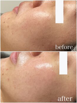 ナーズ(NAZ)/ララピール