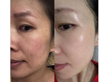 月のひかりの写真/しわシミのお悩み改善へ！潤いをプラスし肌荒れも整える至福のエステ体験を♪