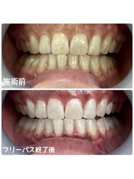 ホワイトニングサロン 京都烏丸店/ホワイトニング施術例