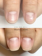 マリーロール 梅田店(Marie Laure)/自爪育成/深爪矯正/ネイルケア