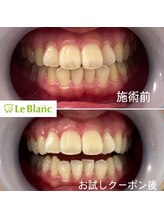 ルブラン 奈良店(Le Blanc)/大好きな紅茶で黄ばんでしまう…