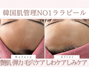 Cスキンケアクリニック 麻布店/ララピールBeforeAfter