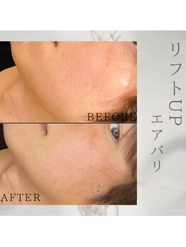 美バリ 新宿店(美BARI)/エアバリ 1回