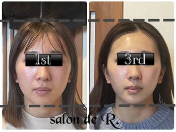 サロン ド アール(salon de R.)/【小顔骨氣・3回の施術効果】