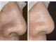 ビューティーサロン ビビ(Vivi)の写真/毛穴の黒ずみ、ざらつき、たるみケア全てが集結された【毛穴改善コース】