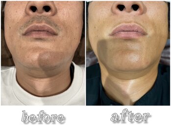 メンズ スリーク(Men's SLEEK)/【ヒゲ脱毛】Before→After