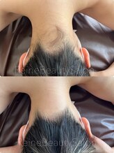 レーヌ(Reine)/うなじ・えりあし脱毛