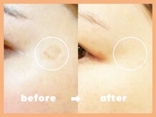 モルティープリマクラッセ 宇都宮東店(Molti Prima Classe)/シミケア/光フェイシャル