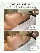 シーフェイス 横浜店(SEE FACE)/ダウンタイム×ハーブピーリング