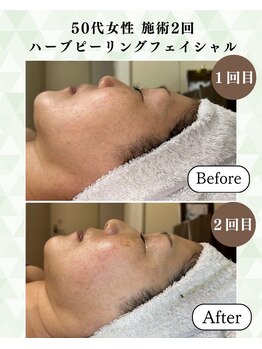 シーフェイス 横浜店(SEE FACE)/ダウンタイム×ハーブピーリング