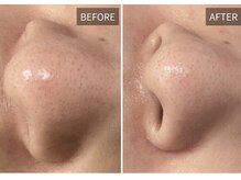 エナ(ENA)/毛穴洗浄「皮脂詰まりスッキリ」