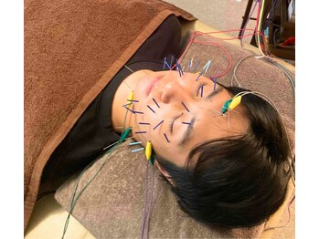 ビープラス鍼灸整骨院(B+鍼灸整骨院)の写真/メンズ美容鍼で頭皮・肌質ケア！抜け毛や眼精疲労にも◎男性の悩みもサポート♪