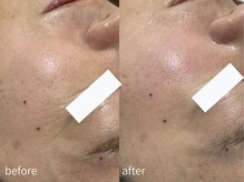 サロン ウル(salon Uru.)/小じわ軽減、お肌がなめらかに