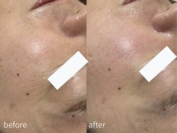 サロン ウル(salon Uru.)/小じわ軽減、お肌がなめらかに
