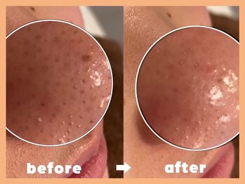 モルティー 宇都宮東店(Molti)/毛穴ケア/肌質改善