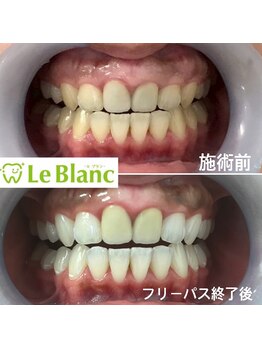 ルブラン 奈良店(Le Blanc)/姉妹でホワイトニング