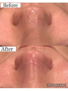 ウォーム(Warm)/黒ずみ黄色い角栓の処置は早めに