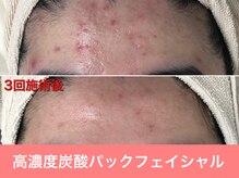 ミスターアンクール 鹿児島(Mr.uncoeur)/おまかせ肌ケア