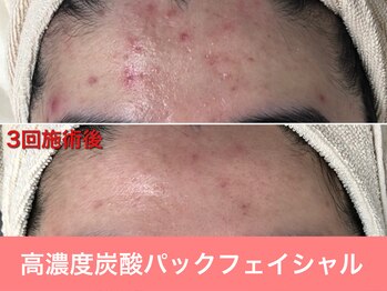 ミスターアンクール 鹿児島(Mr.uncoeur)/おまかせ肌ケア