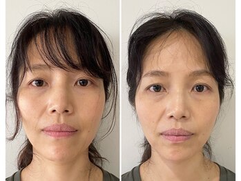 ビー バランス(Be.BALANCE)/ダイヤモンド小顔矯正