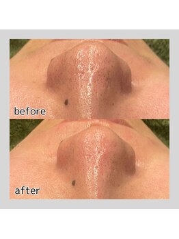 アデル 久留米(ADEL)/《全顔》小鼻ワックス