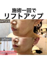 サロンデイジー(Salon Daisy)/Matrix小顔フェイシャル施術一回