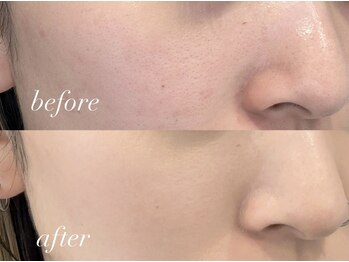 フェイン 青山店(fein.)/毛穴の引き締め効果抜群♪