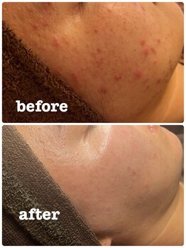 雅菜(miyabina)/長年の肌荒れ悩み。ニキビケア