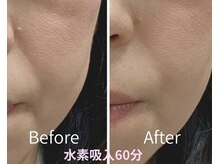 ヨサパーク すずのね(YOSA PARK)/年齢を重ねた方に水素吸入の効果