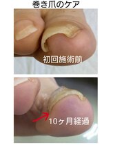 ドクターネイル爪革命 江戸川橋店/巻き爪が何故いけない？