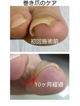 ドクターネイル爪革命 江戸川橋店/巻き爪が何故いけない？