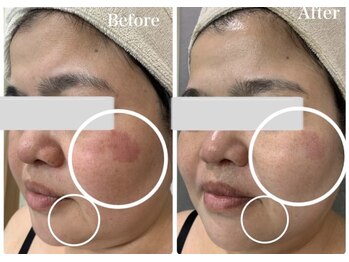 リュミエール デスポワール(Lumiere d'espoir)/ハーブピーリング