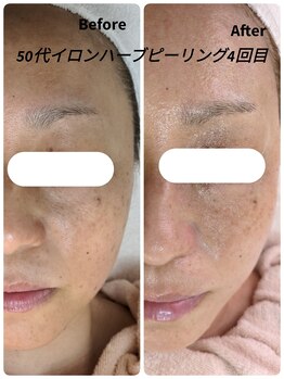 ラヴィアンローズ 蒲郡店(& La vie en Rose)/イロンハーブピーリング4回目