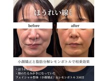 レモンボトル、ほうれい線