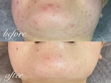 プライベートサロン コットン(COTTON)/肌改善プログラム