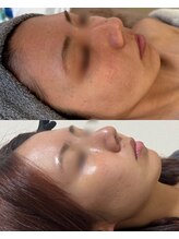 ソア/ハーブリプロ 2回後