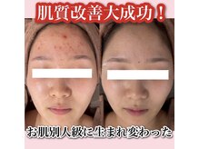 ホワイトアクア 天王寺本店(WHITE AQUA)/ハーブピーリング/大阪/天王寺