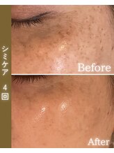 ココロ(COCORO)/シミケア　ビフォーアフター