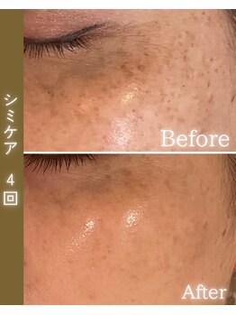 ココロ(COCORO)/シミケア ビフォーアフター