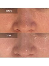 ラリュンヌ(La Lune)/グランタラソトリートメント